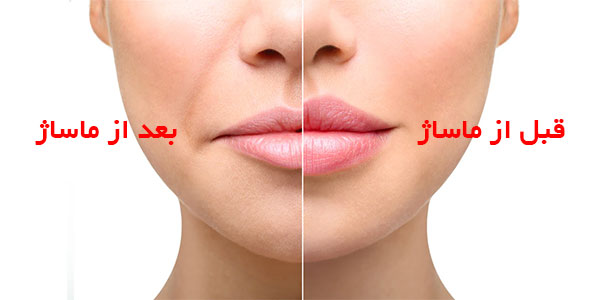 از بین بردن ژل لب با ماساژ