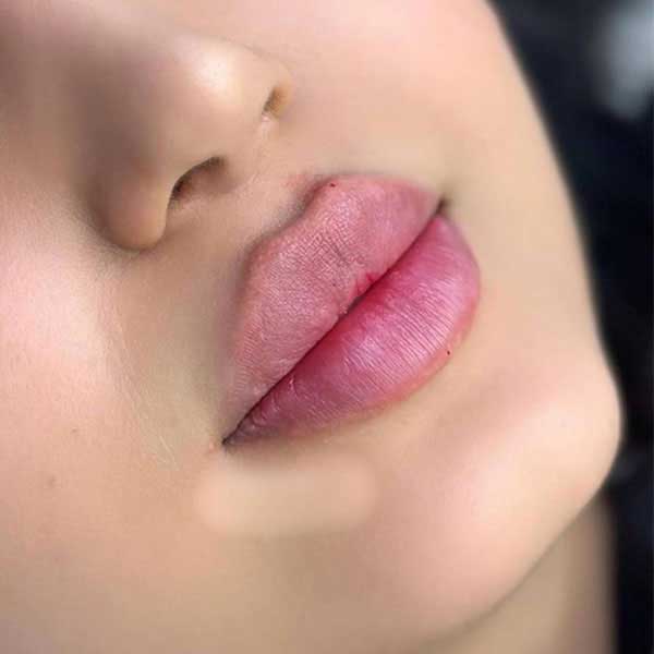 مرکز تزریق ژل لب در گوهردشت کرج