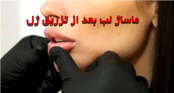 طریقه ماساژ لب بعد از تزریق ژل و تاثیر آن