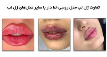 ژل لب مدل روسی خط دار چیست و چه تفاوتی با سایر مدل‌های ژل لب دارد؟