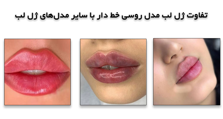 ژل لب مدل روسی خط دار