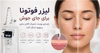 لیزر فوتونا برای جای جوش چقدر موثر است؟