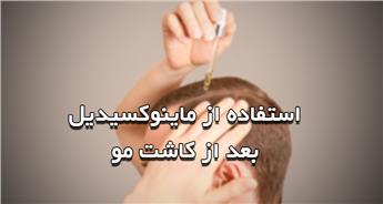 ماینوکسیدیل بعد از کاشت مو و فواید آن