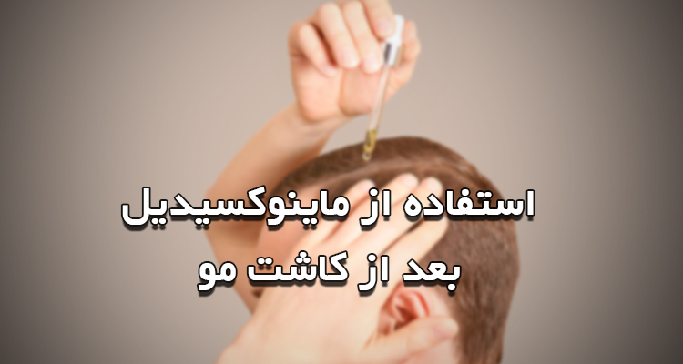 ماینوکسیدیل بعد از کاشت مو
