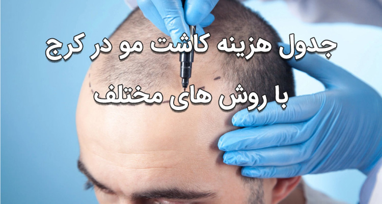 هزینه کاشت مو در کرج